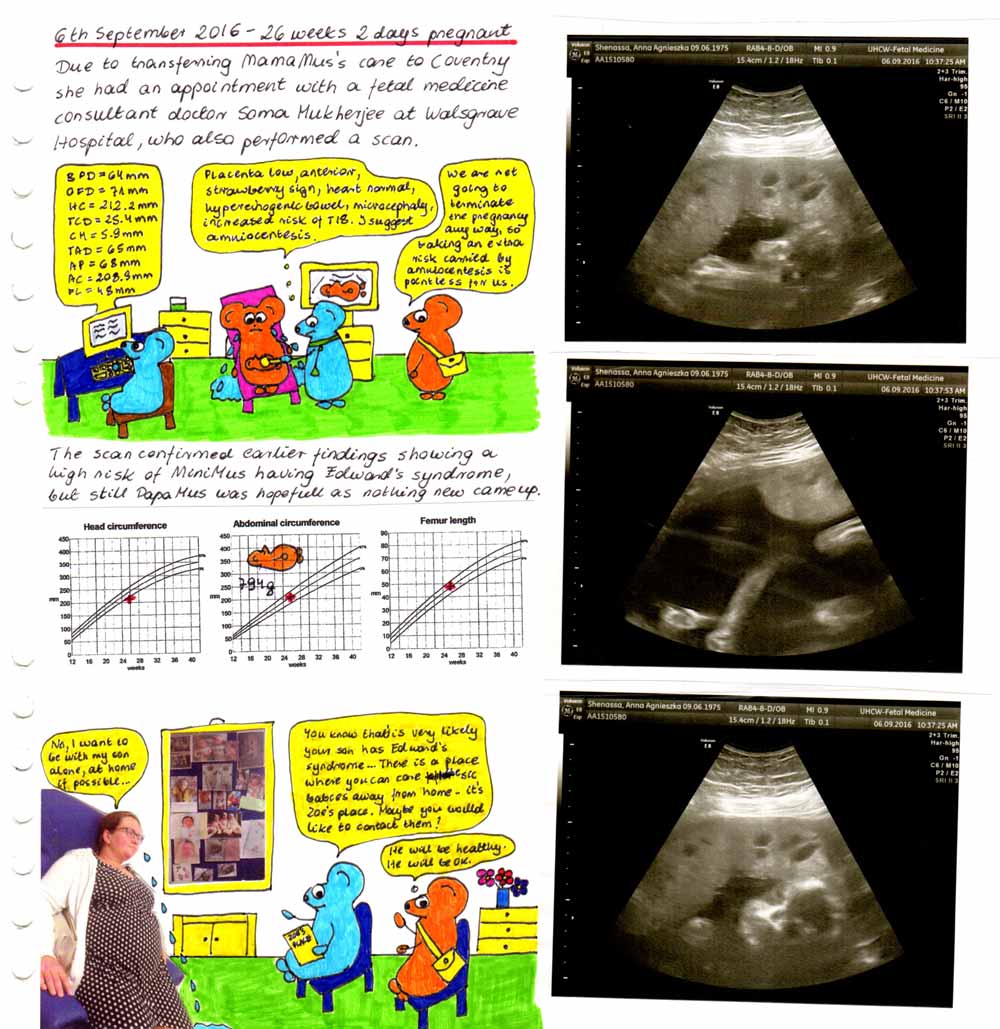 Baby with Trisomy 18 - MiniMus story.